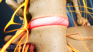 Inflamed disc between two vertebrae, highlighted in red to indicate pain