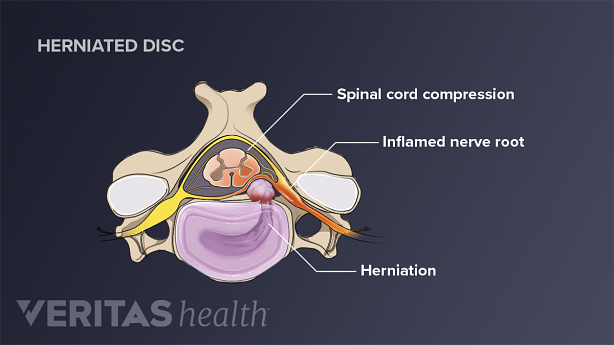 A herniated disc in the neck compressing the spinal cord and nerve root.