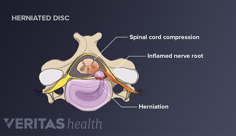 A herniated disc in the neck compressing the spinal cord and nerve root.