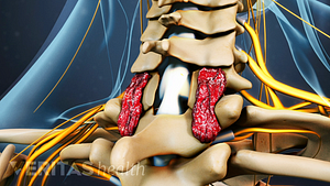 Medical illustration of a cross section view of the location of a cervical laminectomy