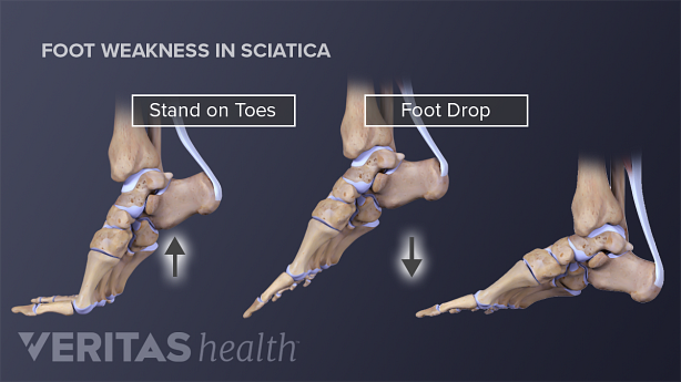 Foot Weakness in Sciatica showing standing on toes and foot drop