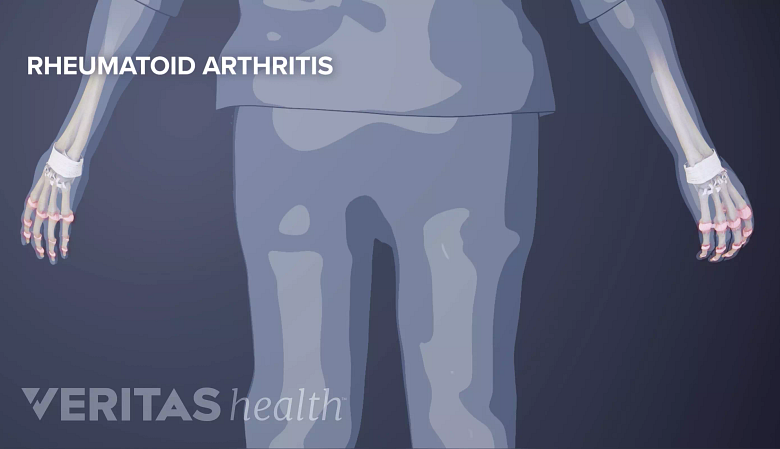 Illustration showing rheumatoid arthritis.