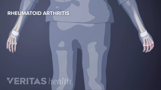 Illustration showing rheumatoid arthritis.