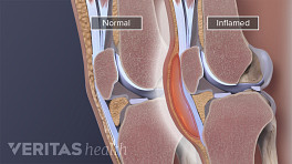 Bursectomy knee complications