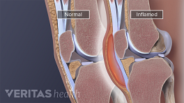 Medical illustration of inflamed knee bursa