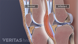 Medical illustration of inflamed knee bursa