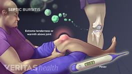 Illustration of septic bursitis showing a high fever and extreme tenderness or warmth above joint.