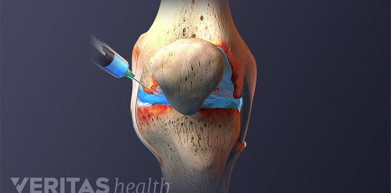Injection into the knee joint.