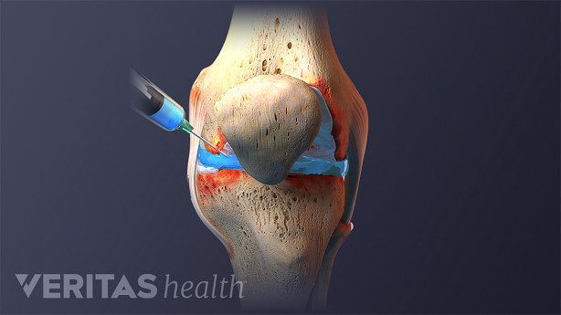 Medical illustration of a knee injection