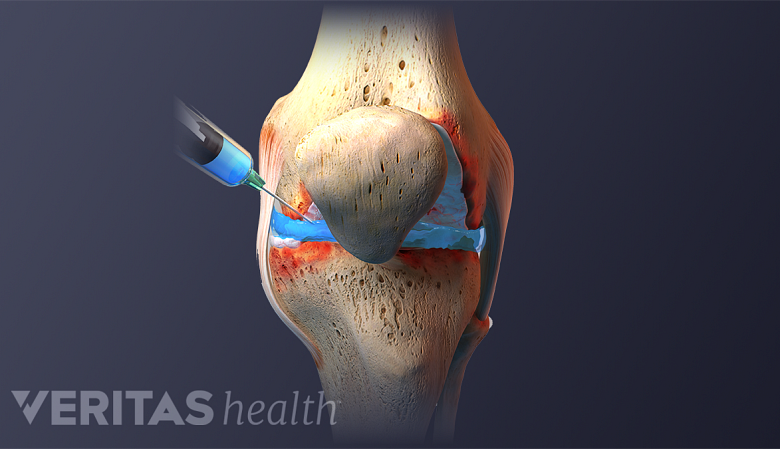 Illustration showing knee joint injection.