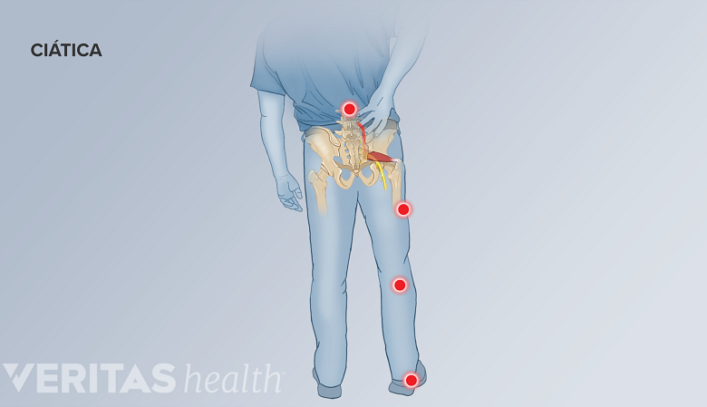 Distribución del dolor de la ciática en la parte inferior de la espalda y la pierna.