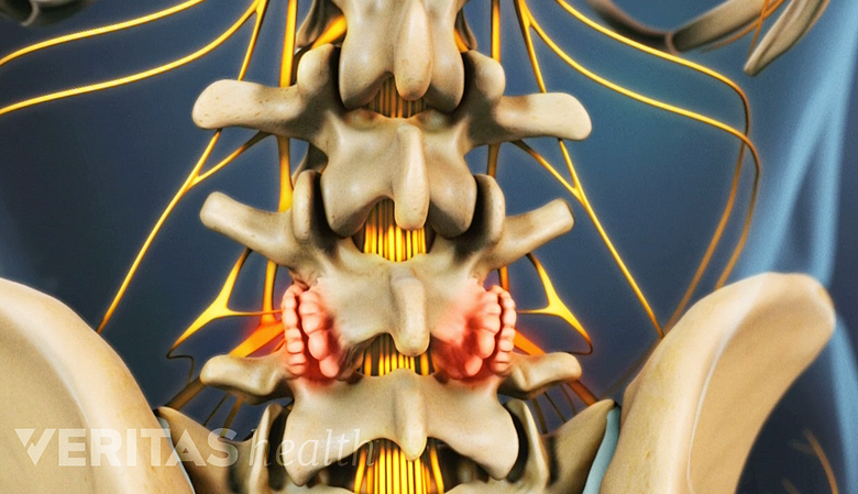 Una ilustración que muestra la osteoartritis de la columna lumbar.