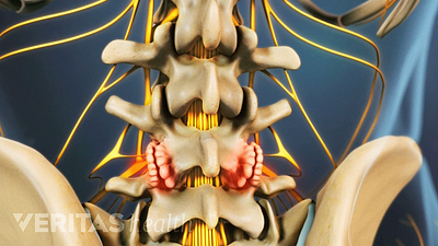 Medical illustration showing bone spurs in the lower spine caused by osteophytes