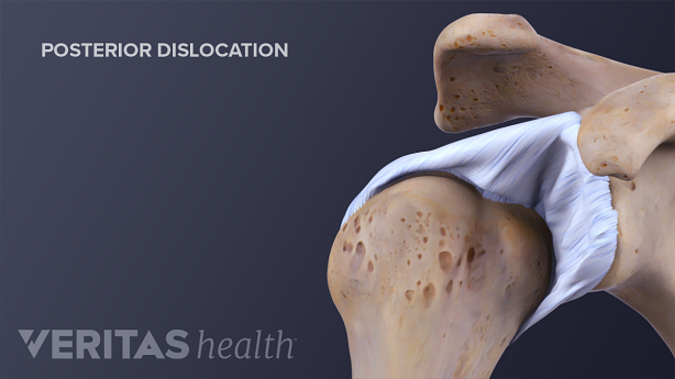 后肩关节脱臼显示锁骨，肩胛骨和关节盂。