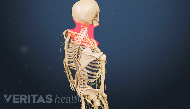 Posterior 3D image of skeleton with neck and head pain locations highlighted in red.
