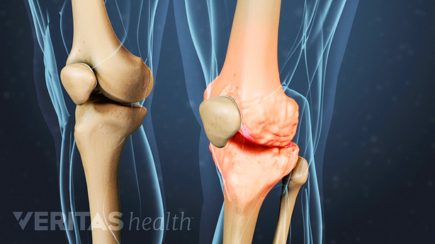 Illustration of Osteoarthritis in a knee joint