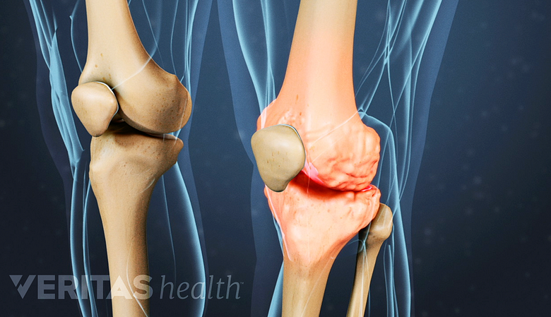 Illustrated skeleton view of osteoarthritis in the knee