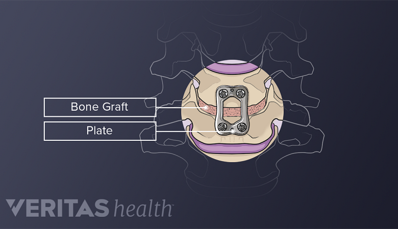 Illustration showing metal plate placed in the cervical vertebra.