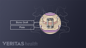 Illustration of fusion highlighting the bone graft and plate.
