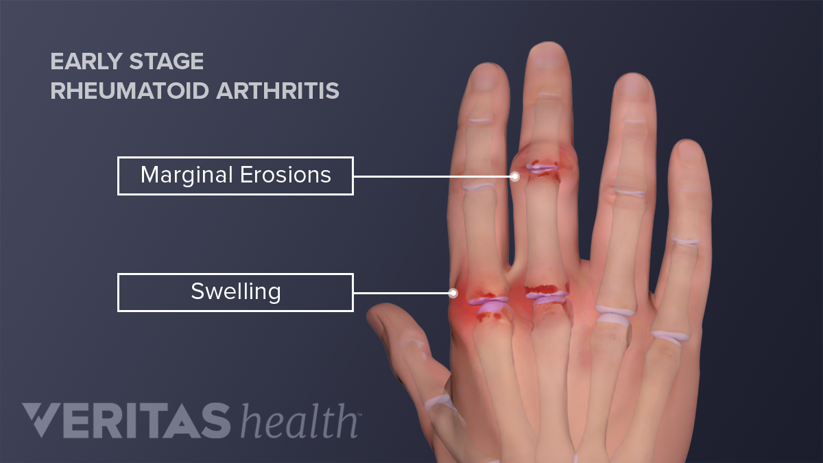 Numbness in fingers: 6 possible causes
