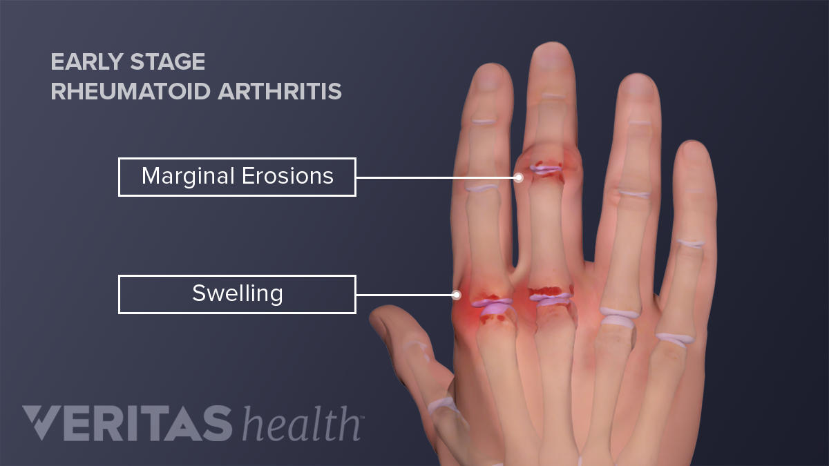 Hand Pain And Rheumatoid Arthritis | Arthritis-health