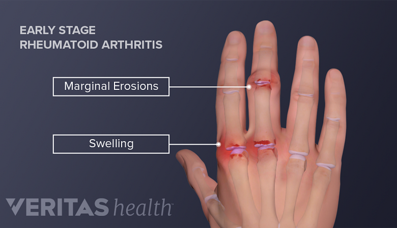 Joint health rheumatoid arthritis