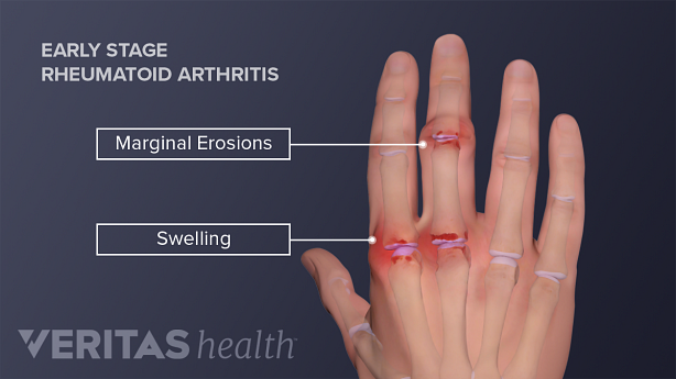 Medical illustration of a hand with rheumatoid arthritis symptoms, including swelling and marginal erosion in the joints