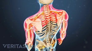Medical illustration of a skeleton. The shoulders and arms are highlighted in red indicating pain, numbness or tingling.