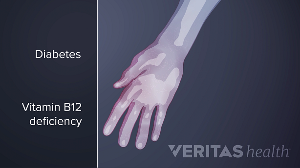Illustration showing hand numbness in b12 deficiency.