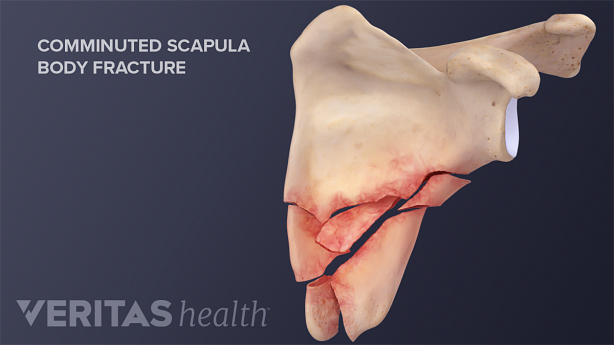A comminuted scapula fracture occurs when the scapula breaks into more than three fragments.
