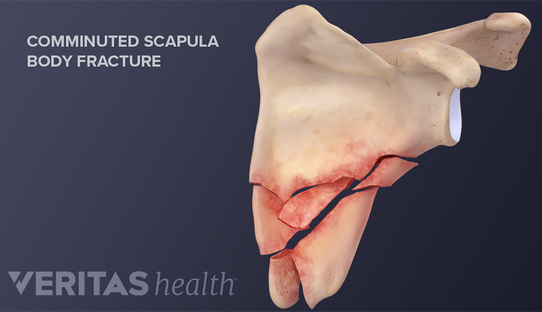 A comminuted scapula fracture occurs when the scapula breaks into more than three fragments.