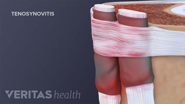 De Quervain’s tenosynovitis cause thumb pain and stiffness