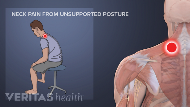Illustration showing a man sitting in a bad posture and neck muscle highlighted in red.