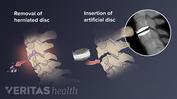 Disc Replacement using an artificial disc showing removal of herniated disc and insertion of artificial disc