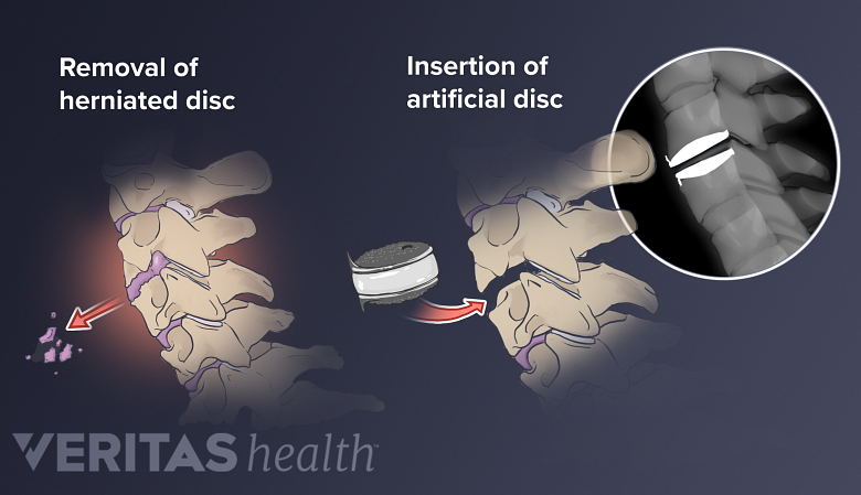 Surgical process of an artificial disc replacement surgery.