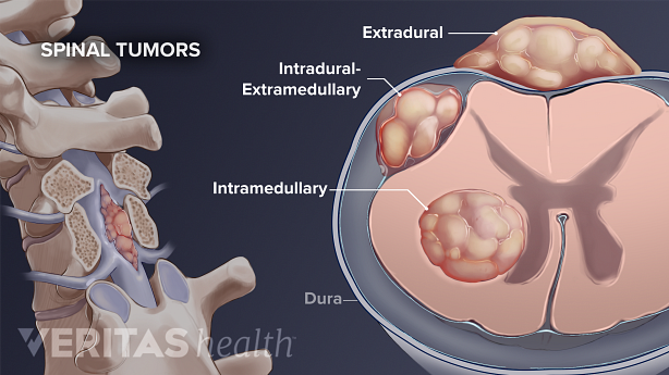 3 types of tumors originating in the spine.