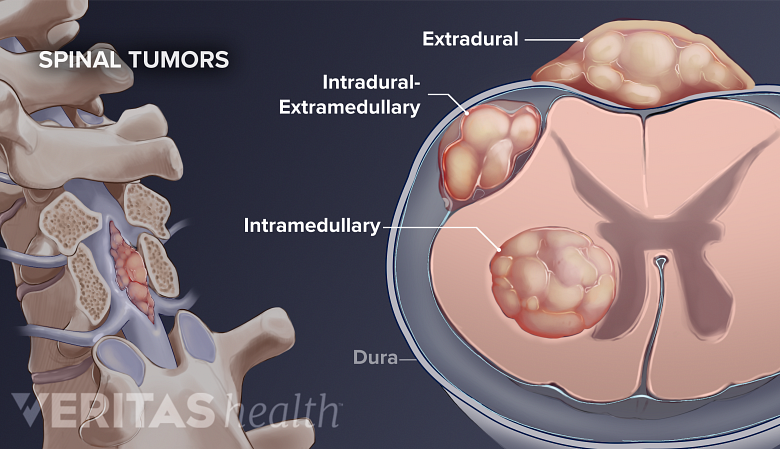 Illustration showing spinal tumor with a cross-section of  spinal cord showing extramedullary and intramedullary tumors.