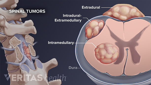 Diagram showing three types of spinal tumors: extradural, intradural-extrmedullary, intramedullary