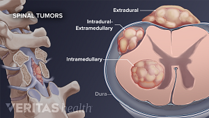 Extradural, intradural-extramedullary, and intramedullary tumors in a vertebrae.