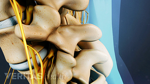 Profile view of lumbar spine with nerve roots inflamed.