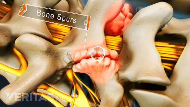 Medical illustration showing bone spurs in the spine caused by osteophytes