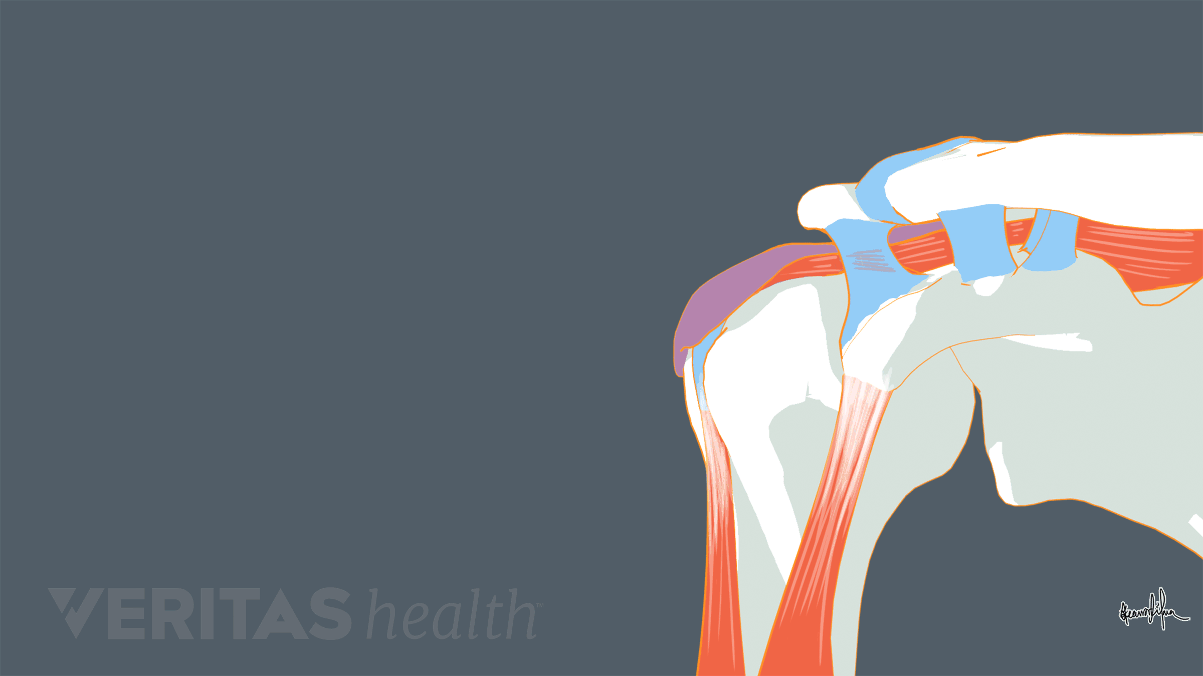 Animation showing abduction with shoulder impingement