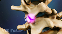 Facet joint highlighted between two vertebra.