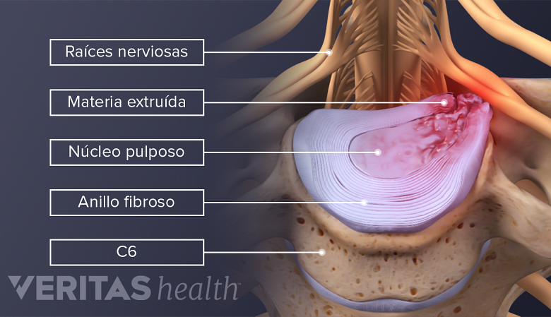 Los componentes de una hernia discal cervical.