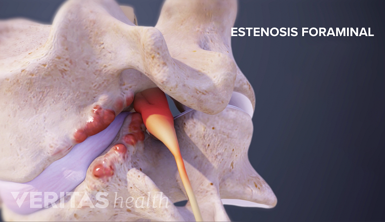 Estenosis foraminal de una vértebra cervical.