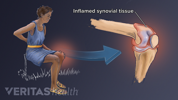 Illustration of inflamed synovial tissue in the knee cause by psoriatic arthritis