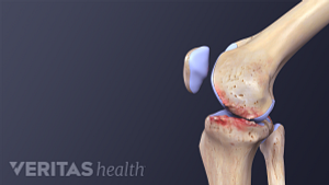 Illustration of a side view of a knee with osteoarthritis