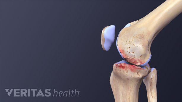 Illustration of a side view of a knee with osteoarthritis in the knee