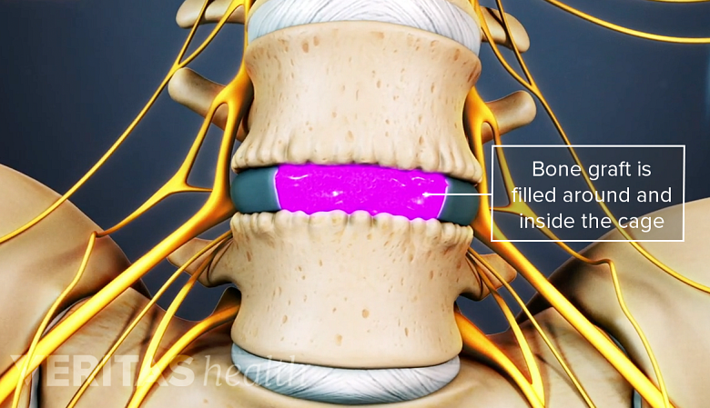 Illustration showing bone graft in fusion surgery.