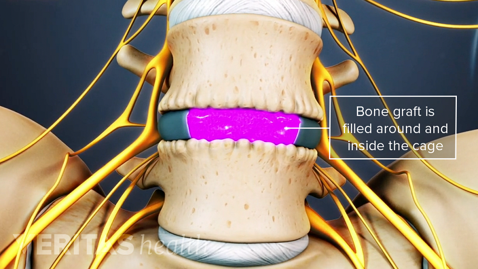 Bone graft is filled around and inside the cage